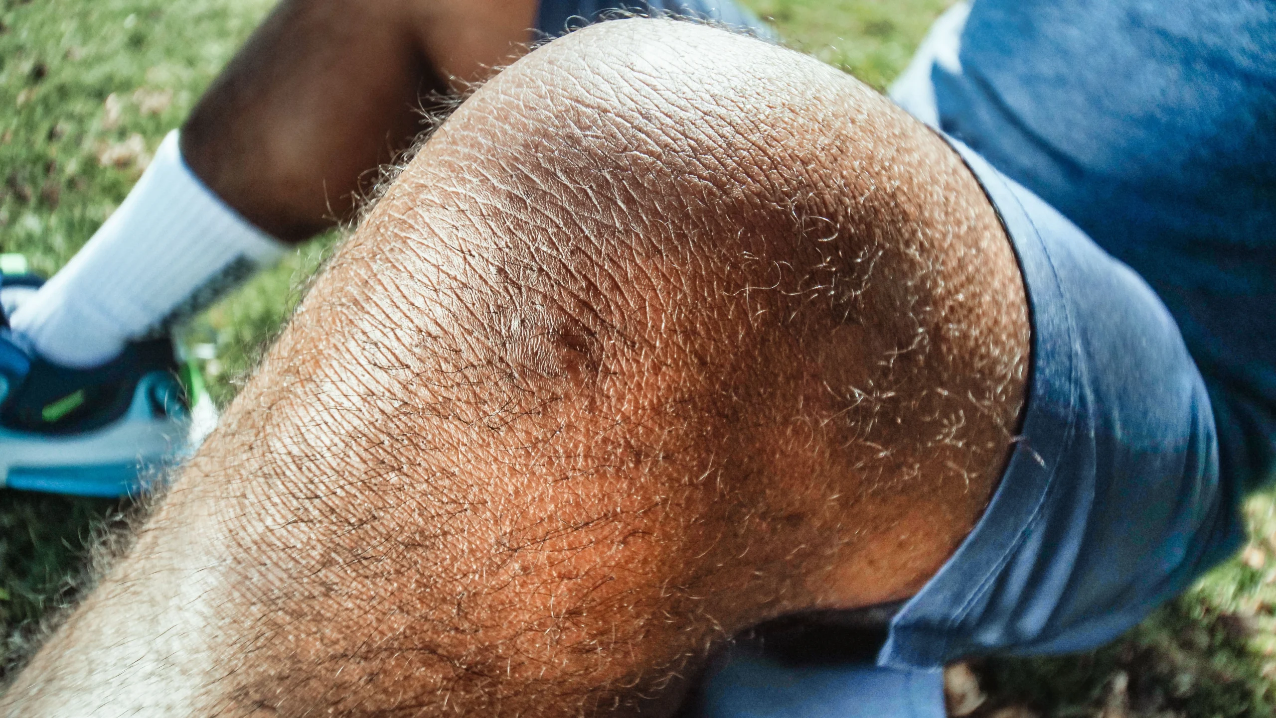Rodilla lesionada e inflamada — esguince de rodilla